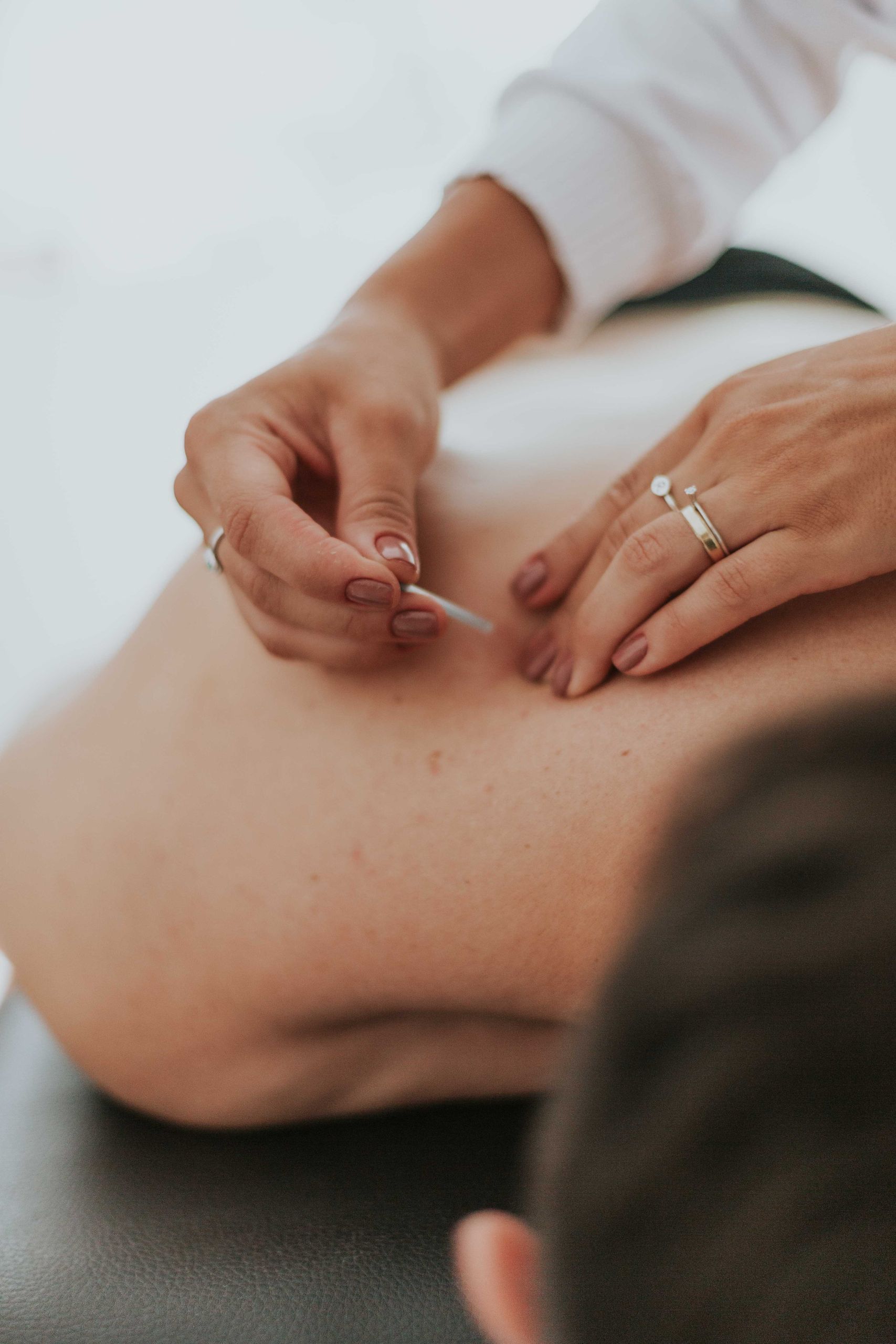 Close-up of a therapist performing acupuncture on a person's back in a calming environment.